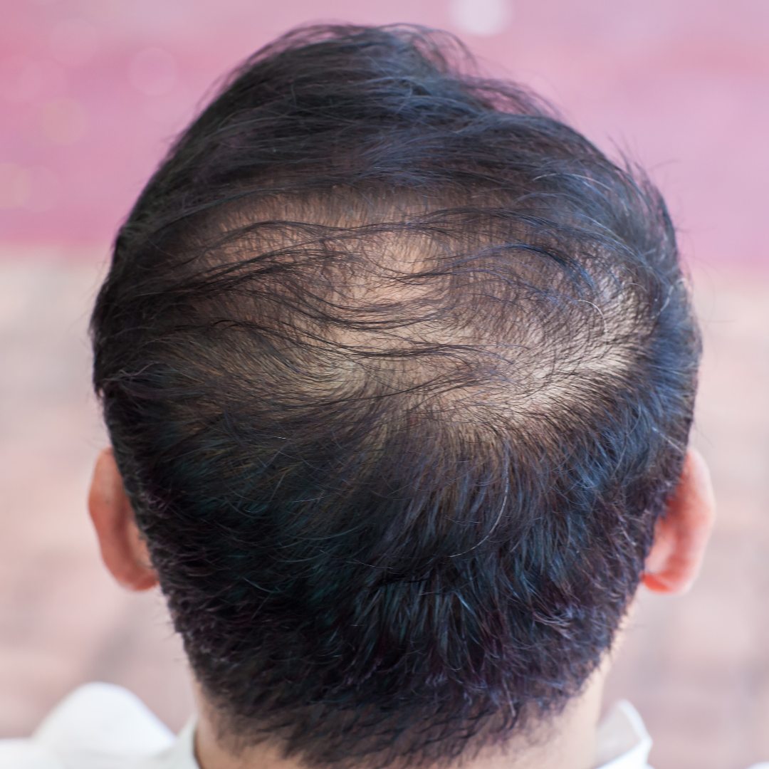 signs of Male Hair Loss