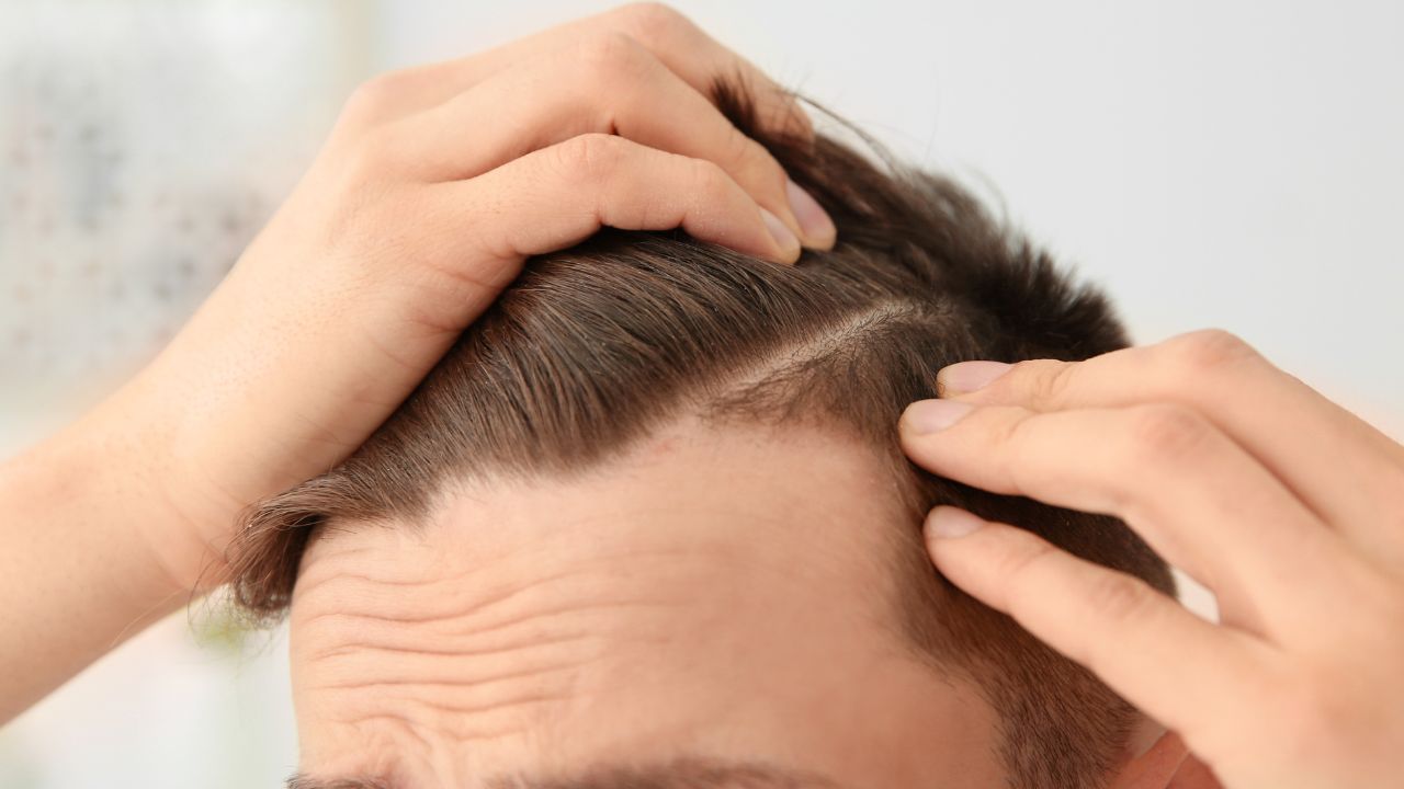 Finasteride _ hair loss treatment