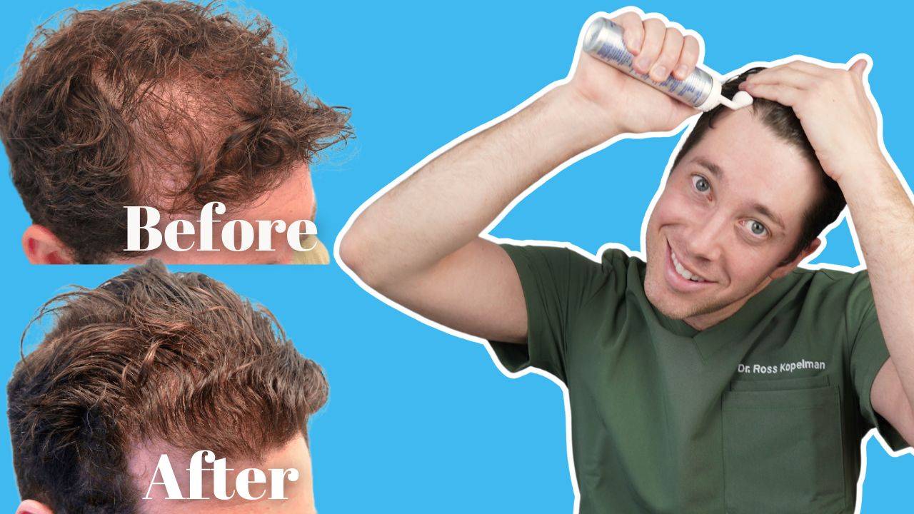 minoxidil treatment for hair loss
