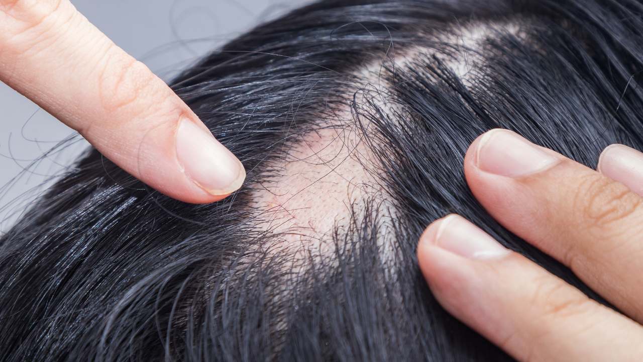 Cortisone Injections for alopecia