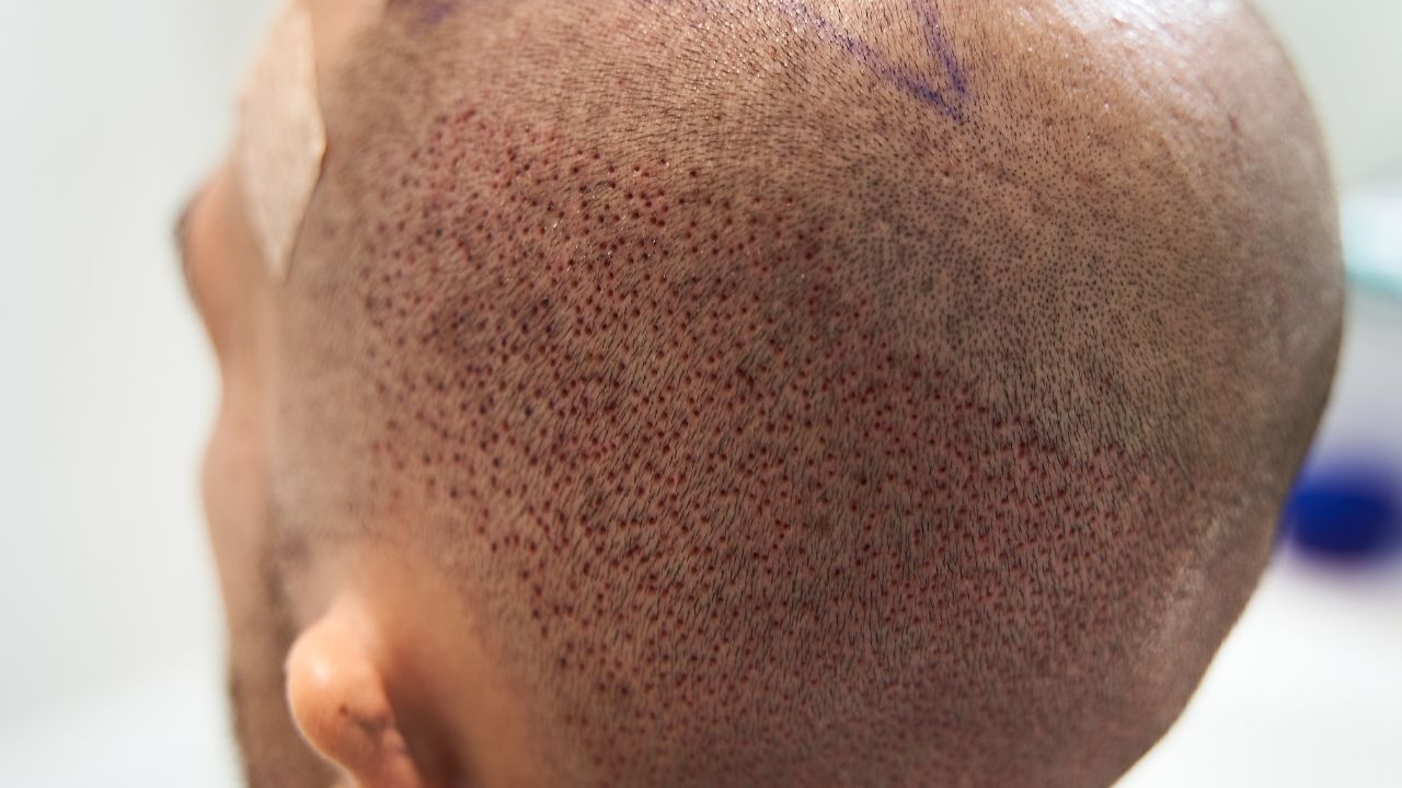 FUE hair transplant technique