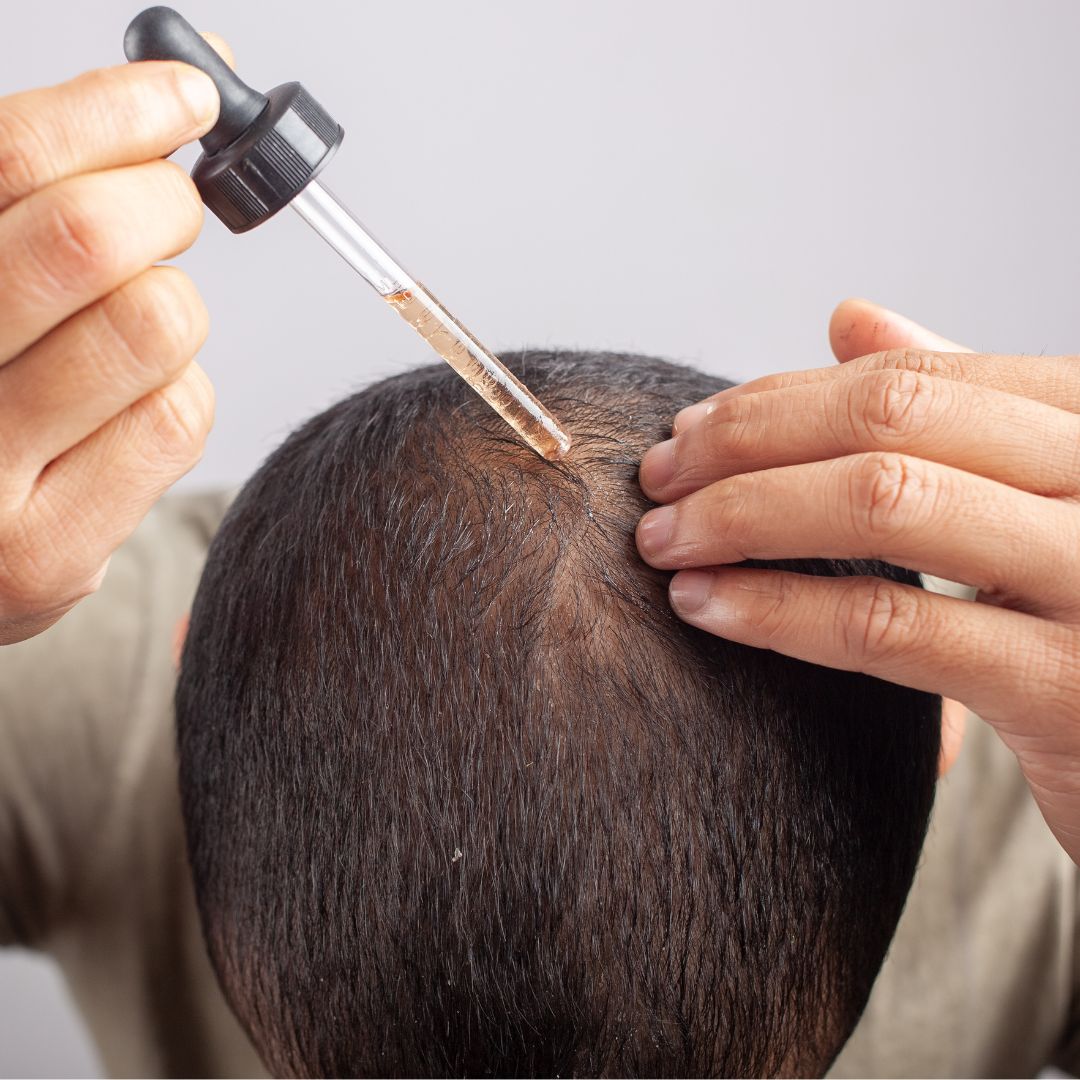 Minoxidil treatment