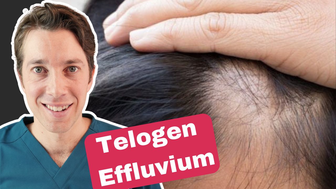 Telogen Effluvium hair shedding