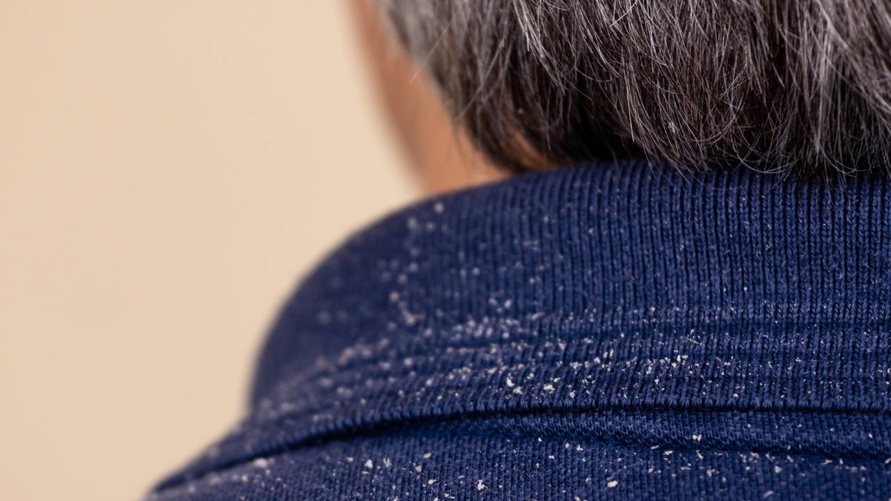 dandruff and hair loss