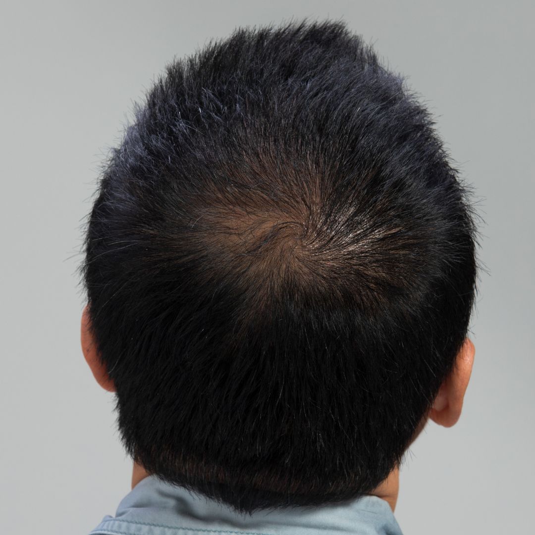 finasteride _ hair treatment candidate