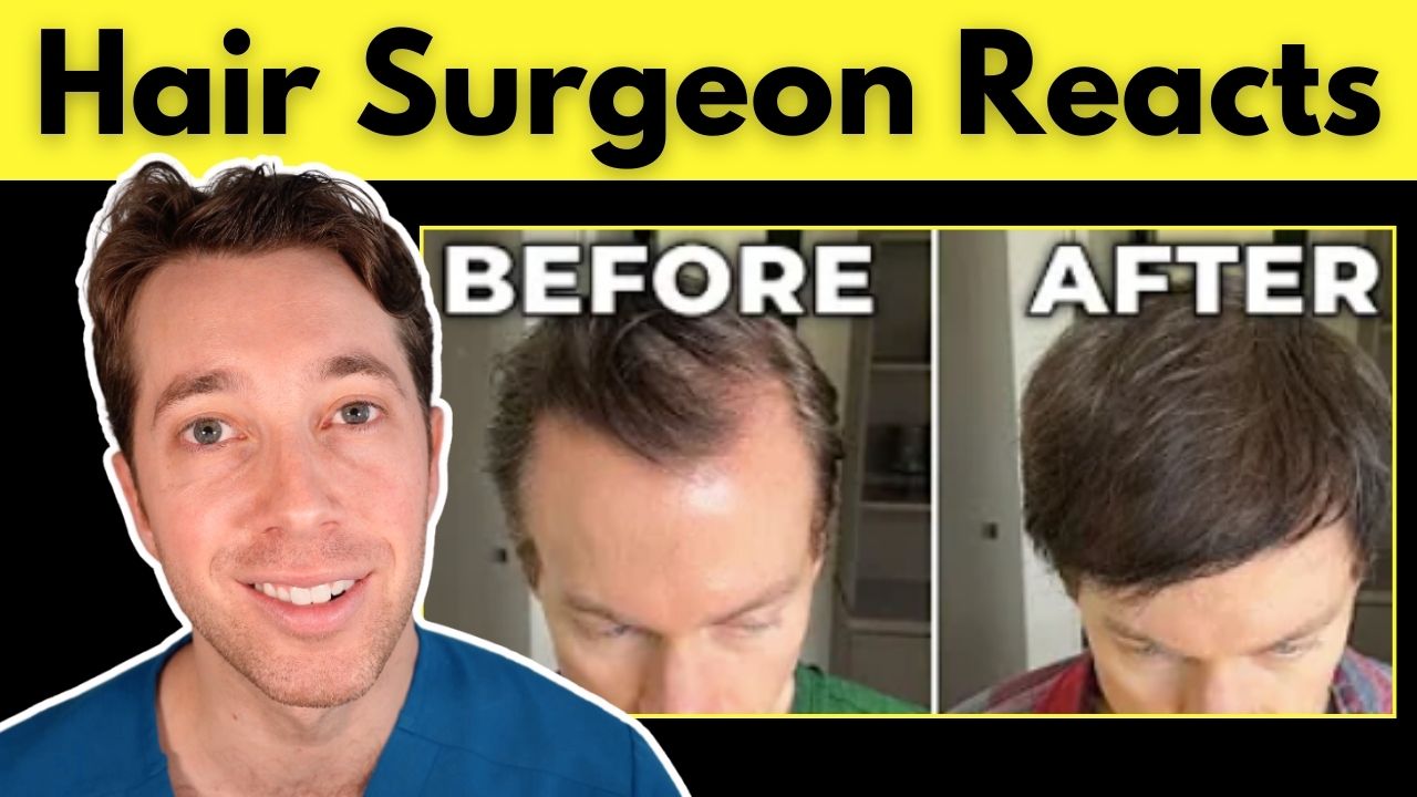 hair surgeon reactions bryan johnson