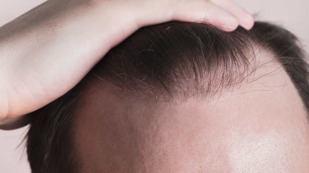 hair transplant in 30s