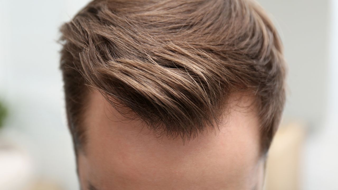 mesotherapy dutasteride hair loss treatment