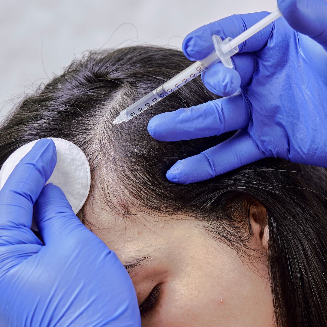 mesotherapy treatment for hair loss
