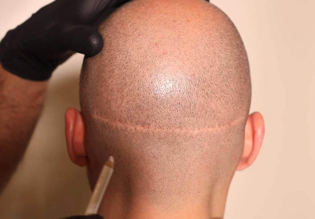 scar from hair transplant