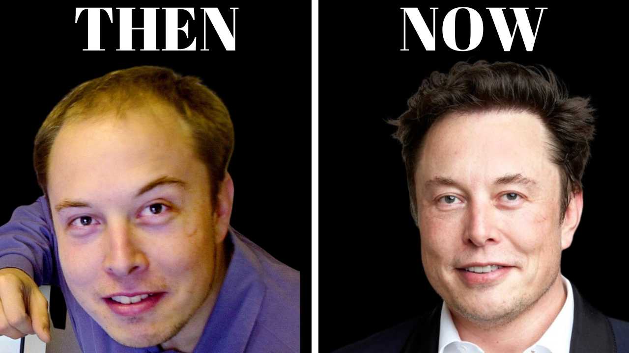 Elon Musk _ Hair Transplant Before and After