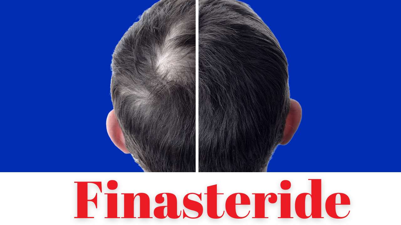 Finasteride FAQs for Hair Loss
