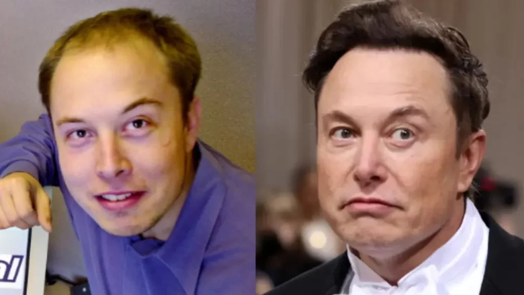 Did Elon Musk Have a Hair Transplant? Before and After