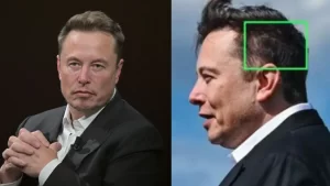 FUT Hair Transplant _ Elon Musk