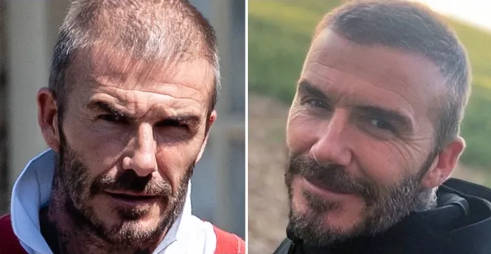 David Beckham's Hair Transplant: What We Know