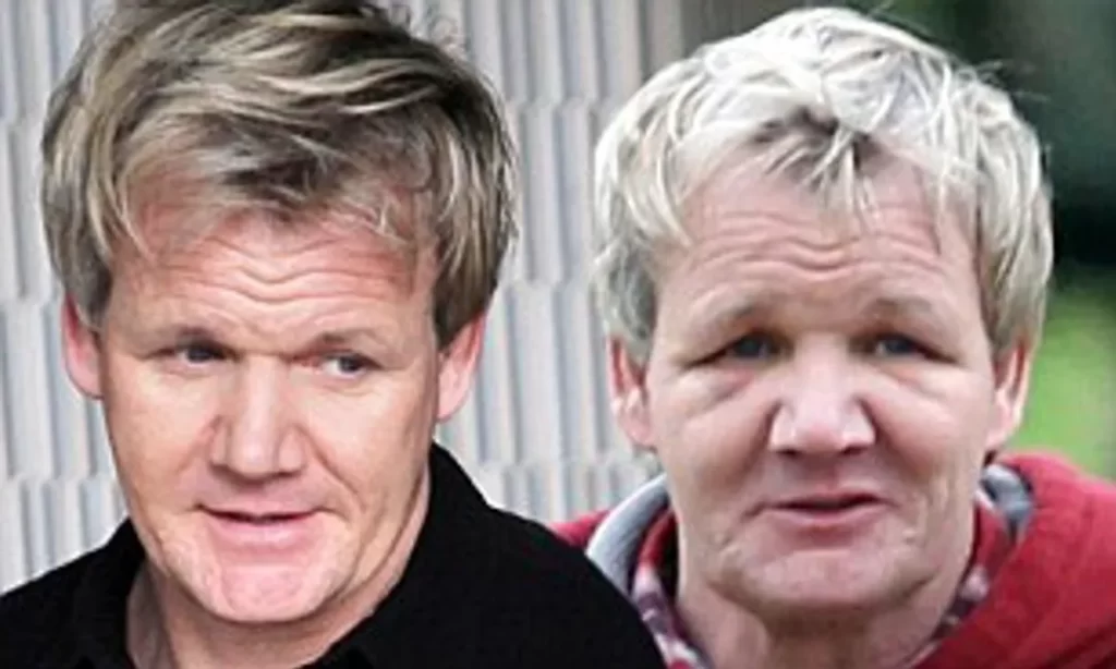 Gordon Ramsay _ hair transplant