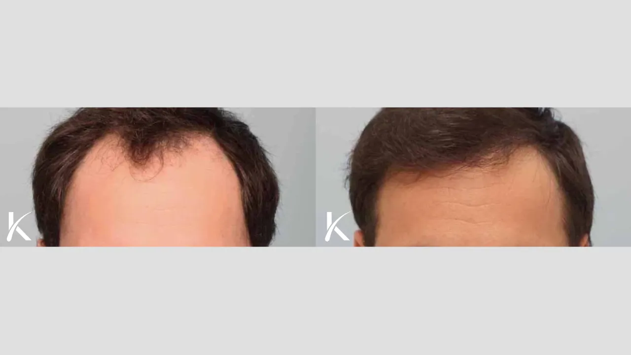 Hair Transplant Before & After Photo _ Male Patient 1