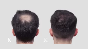 Hair Transplant Before & After Photo _ Male Patient 10