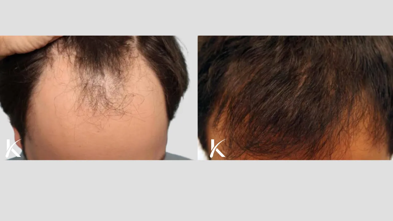 Hair Transplant Before & After Photo _ Male Patient 2