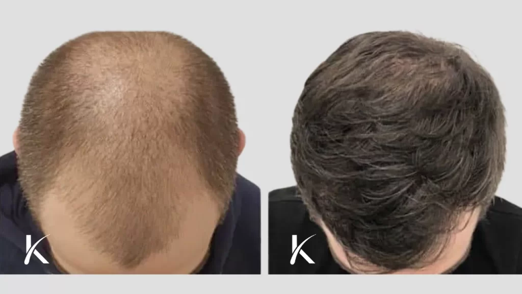 Hair Transplant Before & After Photo _ Male Patient 25