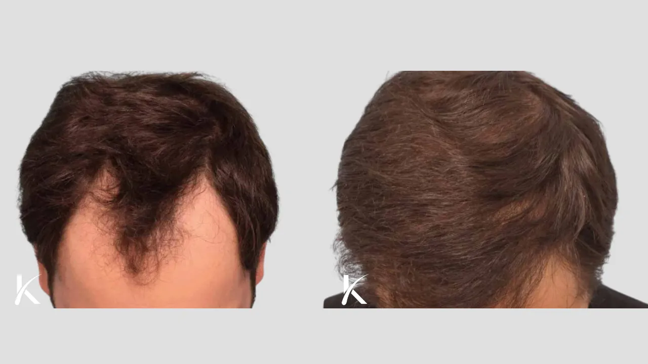 Hair Transplant Before & After Photo _ Male Patient 3