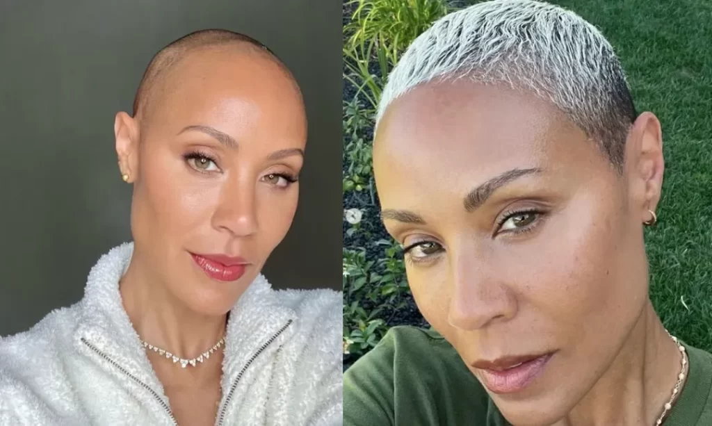 Jada Pinkett Smith _ hair transplant