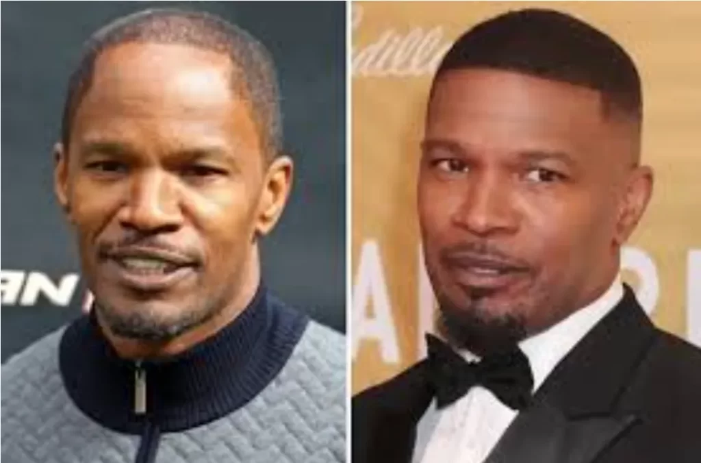 Jamie Foxx _ hair transplant