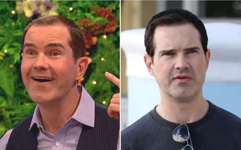 Jimmy Carr hair transplant