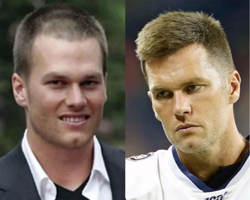 Tom Brady _ Hair Transplant