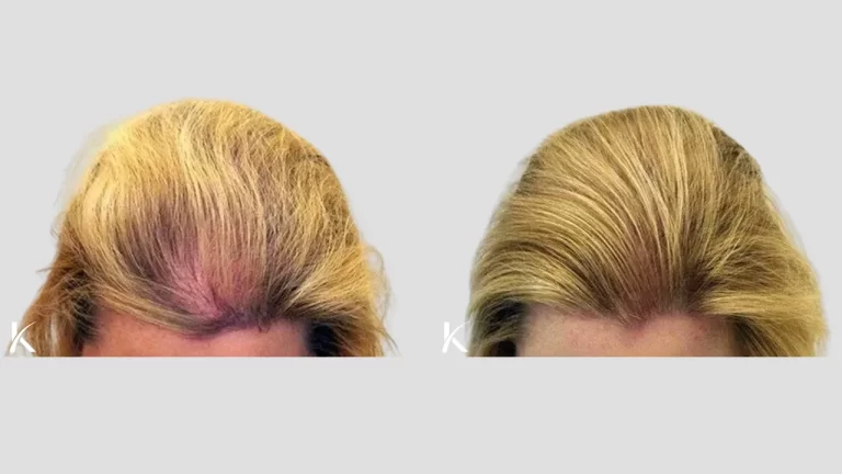 female Patient 1.2 - before and after hair transplant full