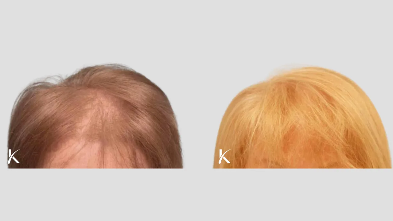 female Patient 2.1 - before and after hair transplant forward