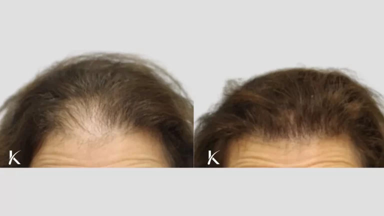 female Patient 7 - before and after hair transplant