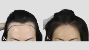 Hair Line Lowering with Hair Transplant Before and After 