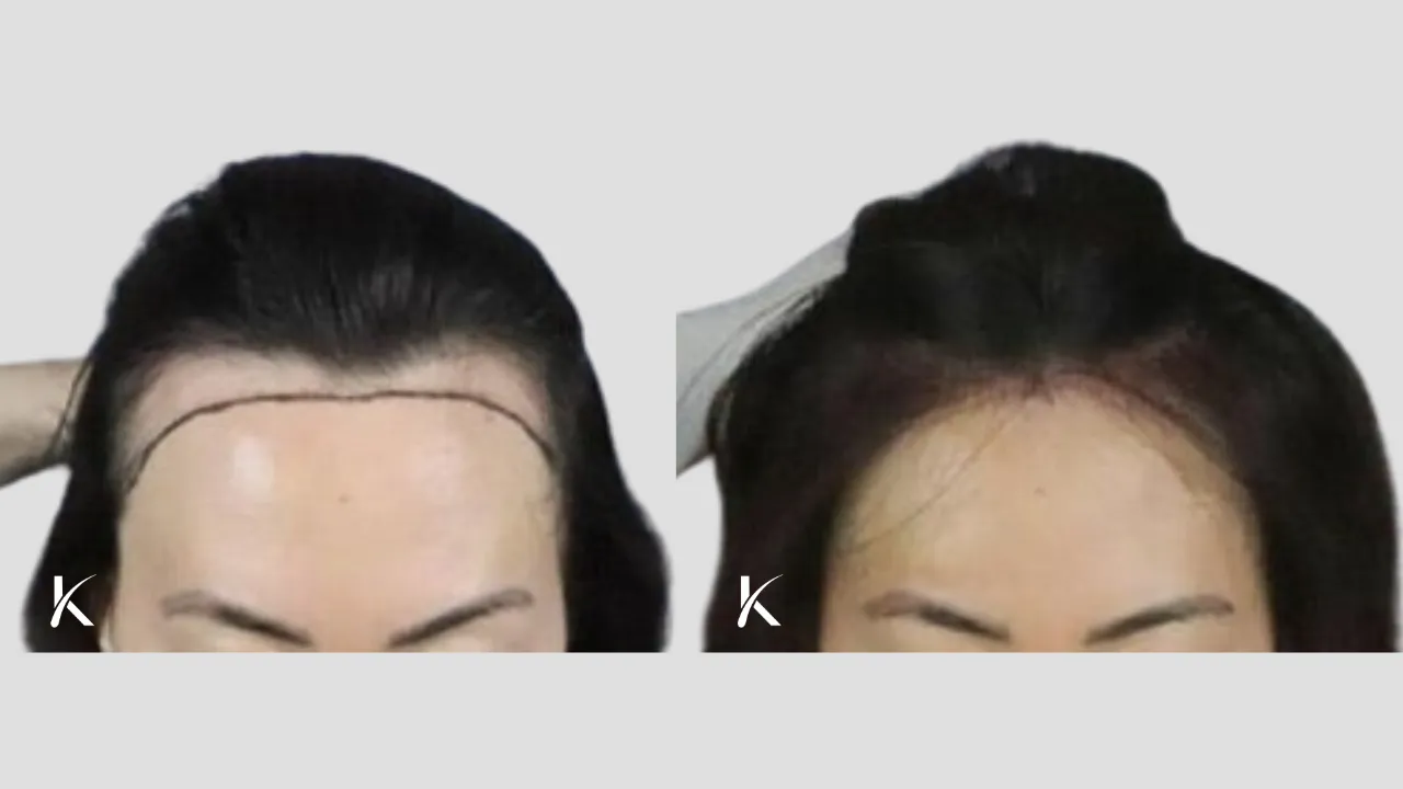 Hair Line Lowering with Hair Transplant Before and After