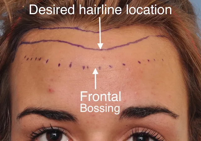 lowering forehead reduction with surgery