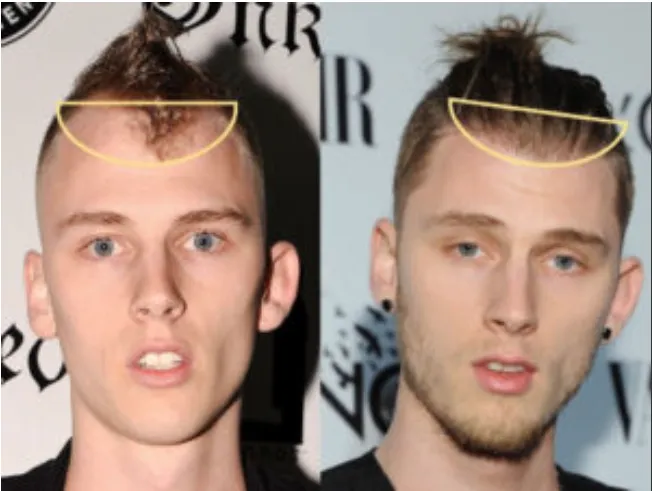 Machine Gun Kelly _ Hair Transplant