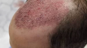 hair transplant cellulitis