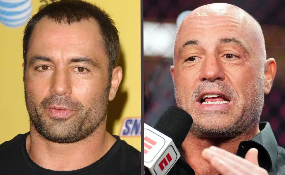 Joe Rogan Hair Transplant His Hair Surgery And Scar Story Kopelman Hair Joe Rogan Hair Transplant His Hair Surgery And Scar Story Kopelman Hair
