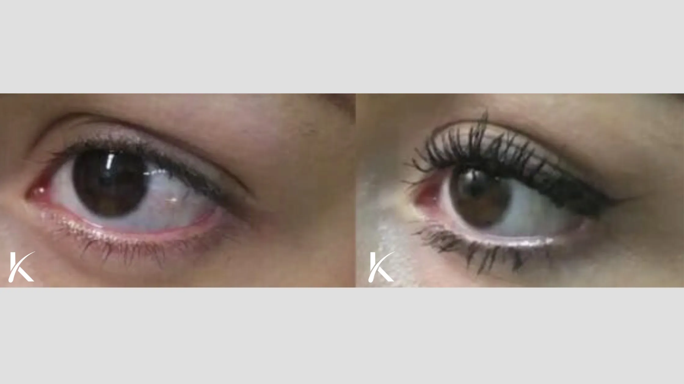 Eyelash Hair Transplant Before and After - Patient 4