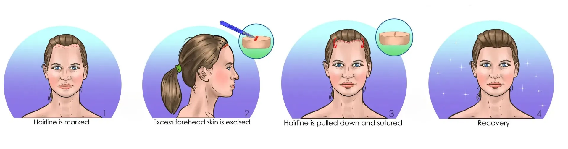 Female Hair Lowering Surgery