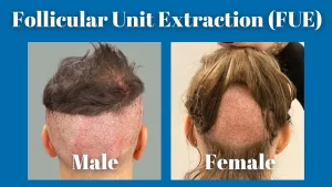 FUE for men vs women