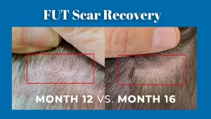 FUT Scar Recovery