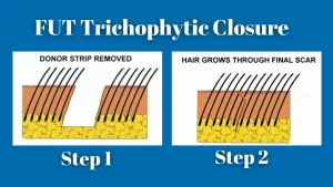 FUT Trichophytic Closure