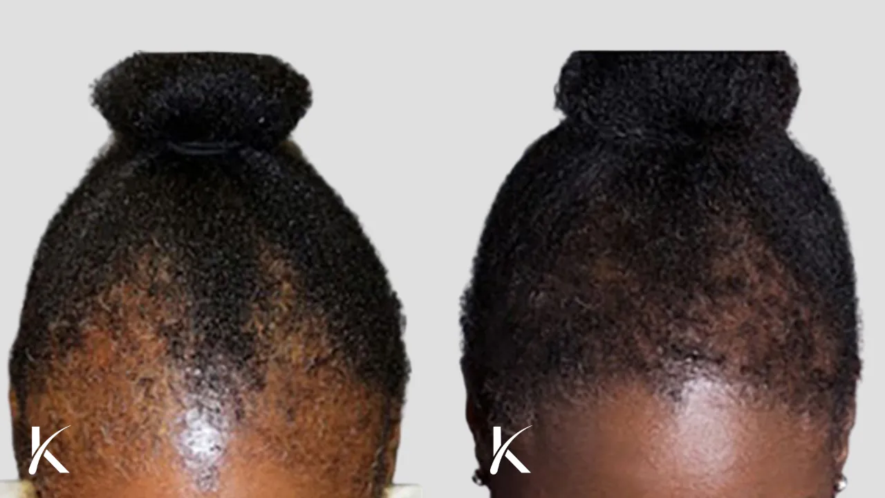 female african american hair transplant before and after (2)