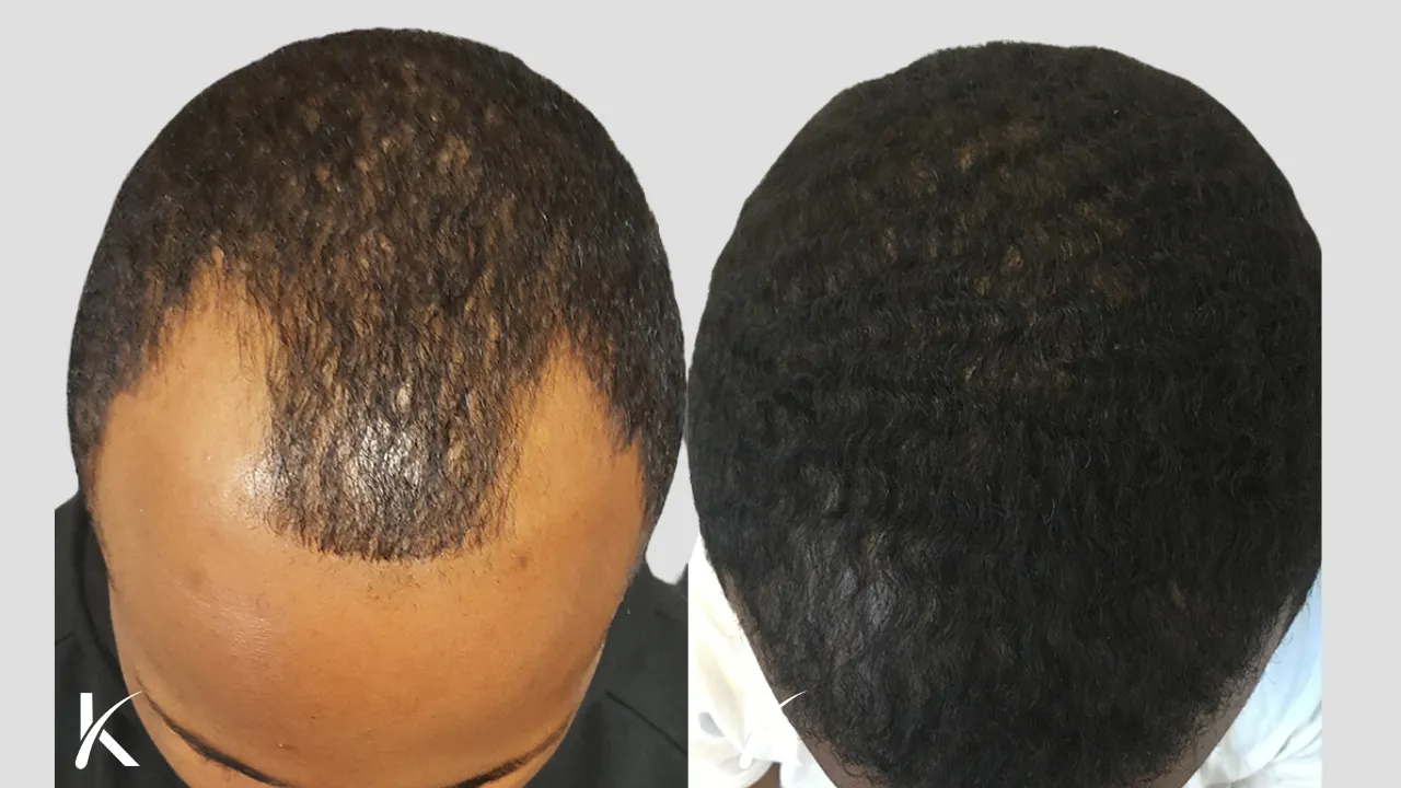 male african american hair transplant before and after (2)