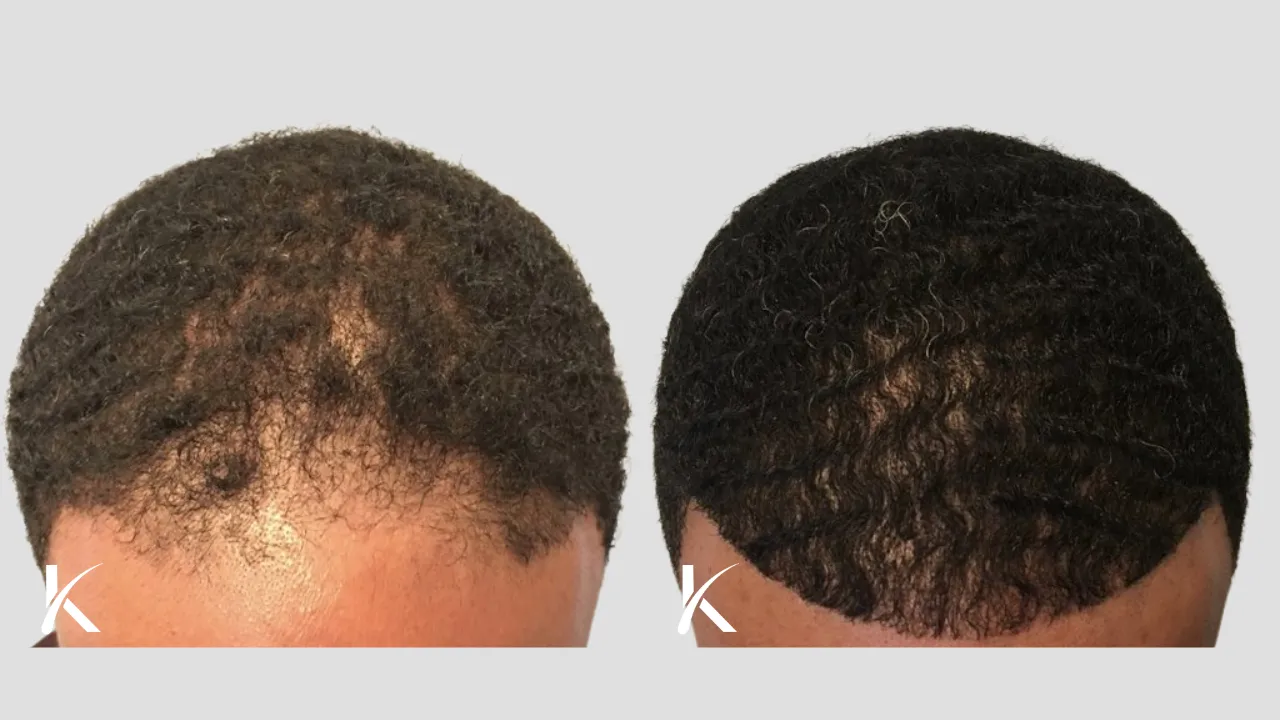 male african american hair transplant before and after