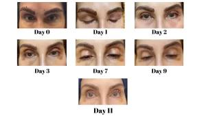 recovery from eyebrow transplant