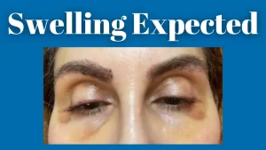 swelling after eyebrow hair transplant