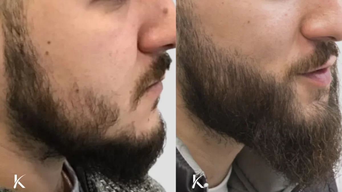 Beard transplant before and after side view