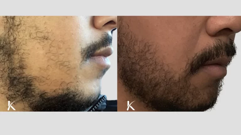 Beard-Hair-Transplant-Before-and-After-_-Patient-7